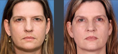 Eyelid Surgery (Upper Blepharoplasty) Before & After Gallery - Patient 102566520 - Image 1