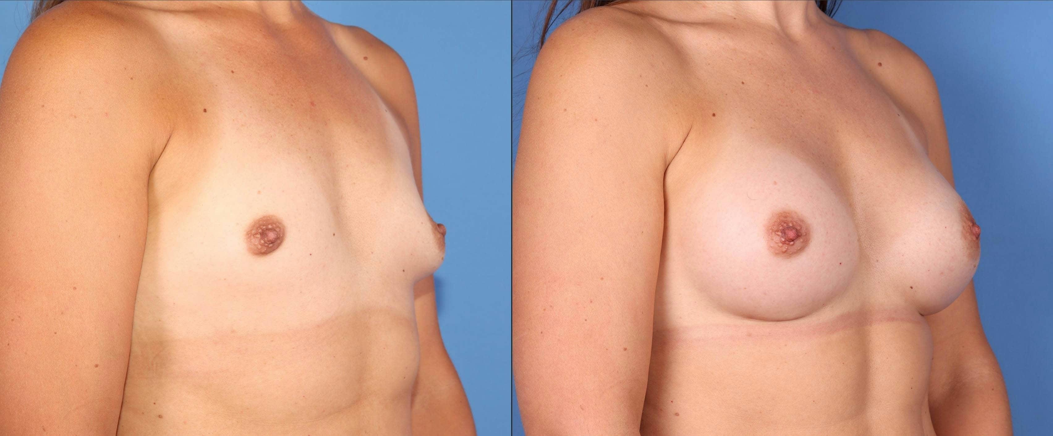 Breast Augmentation Before & After Gallery - Patient 102905031 - Image 2