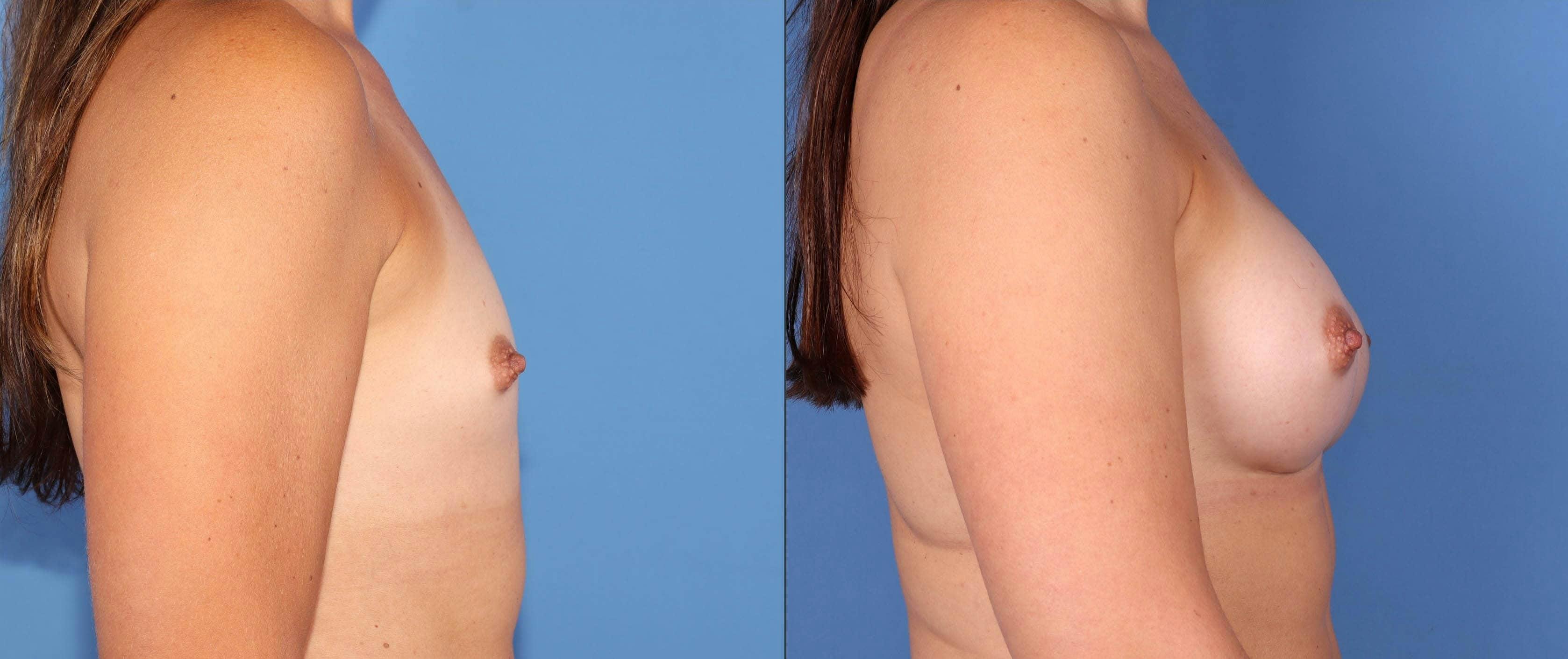 Breast Augmentation Before & After Gallery - Patient 102905031 - Image 3