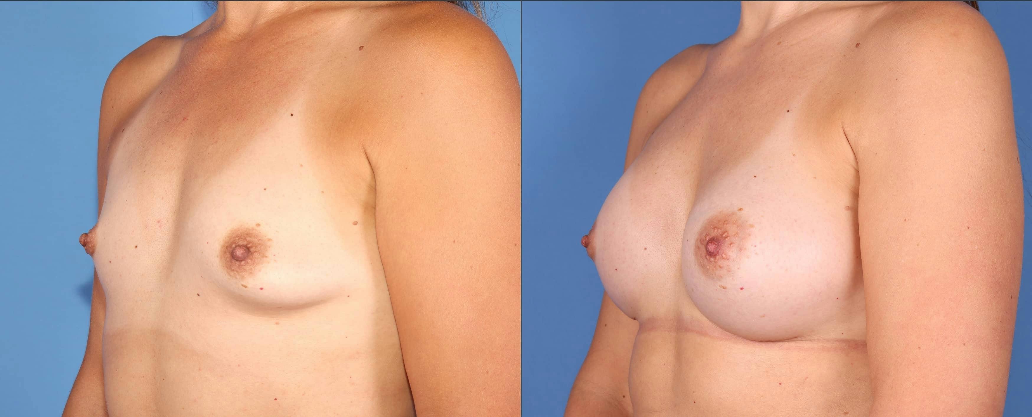 Breast Augmentation Before & After Gallery - Patient 102905031 - Image 4