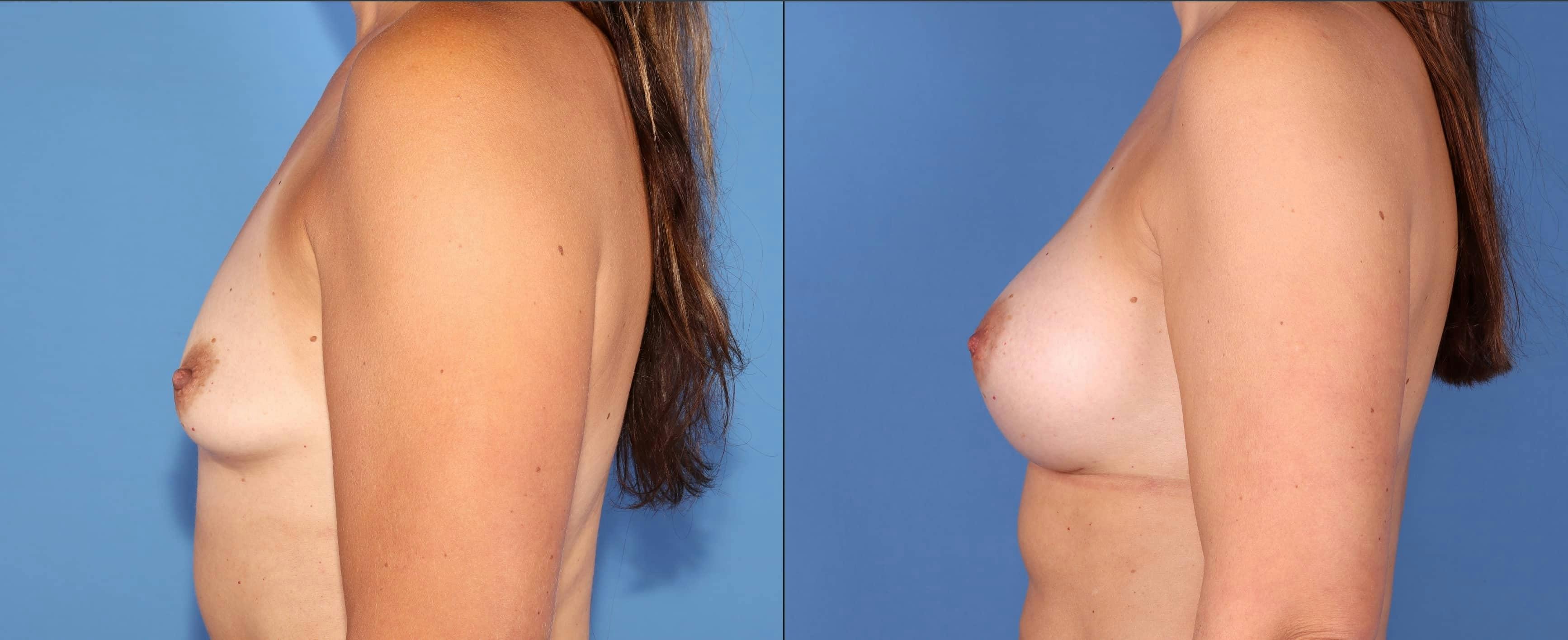 Breast Augmentation Before & After Gallery - Patient 102905031 - Image 5