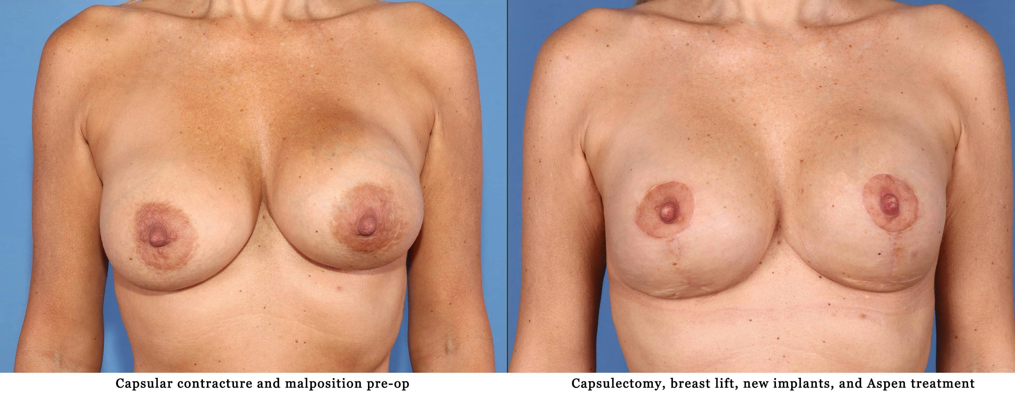 Breast Revision Before & After Gallery - Patient 102927414 - Image 1