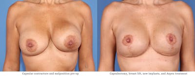 Breast Revision Before & After Gallery - Patient 102927414 - Image 1