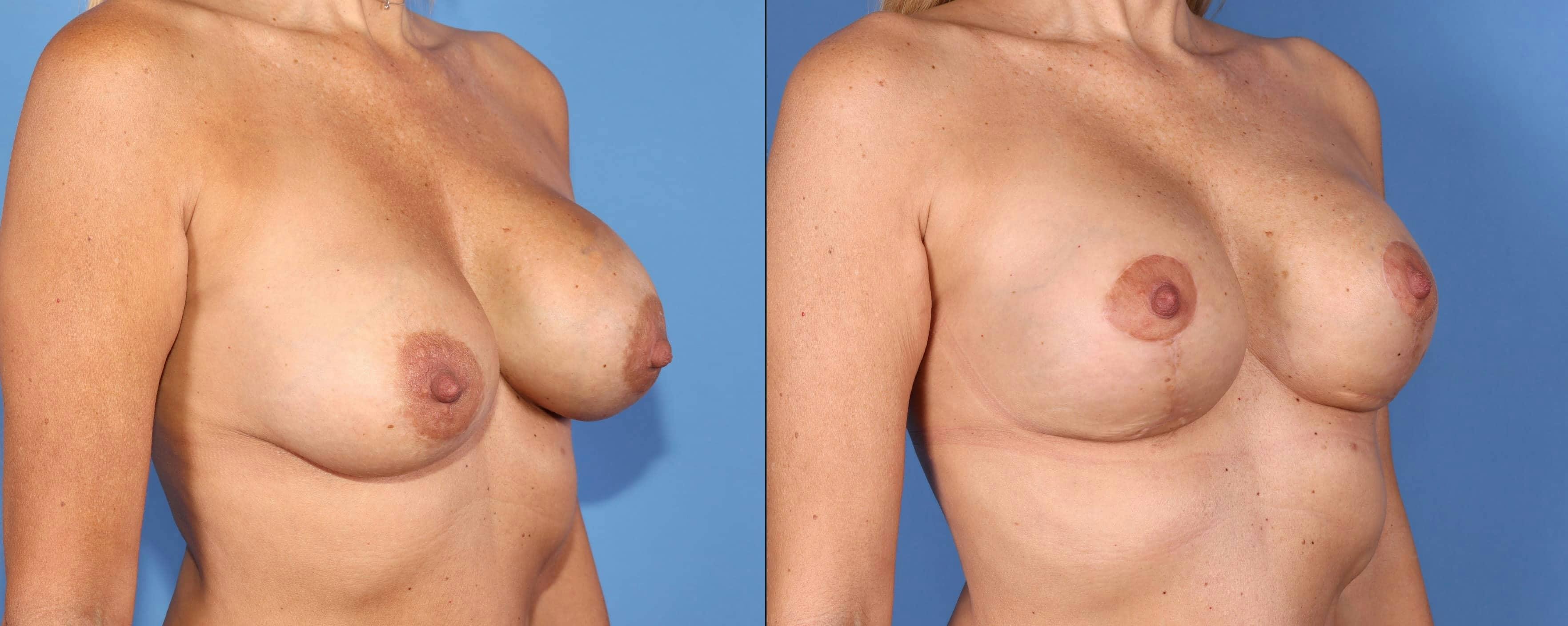 Breast Revision Before & After Gallery - Patient 102927414 - Image 2