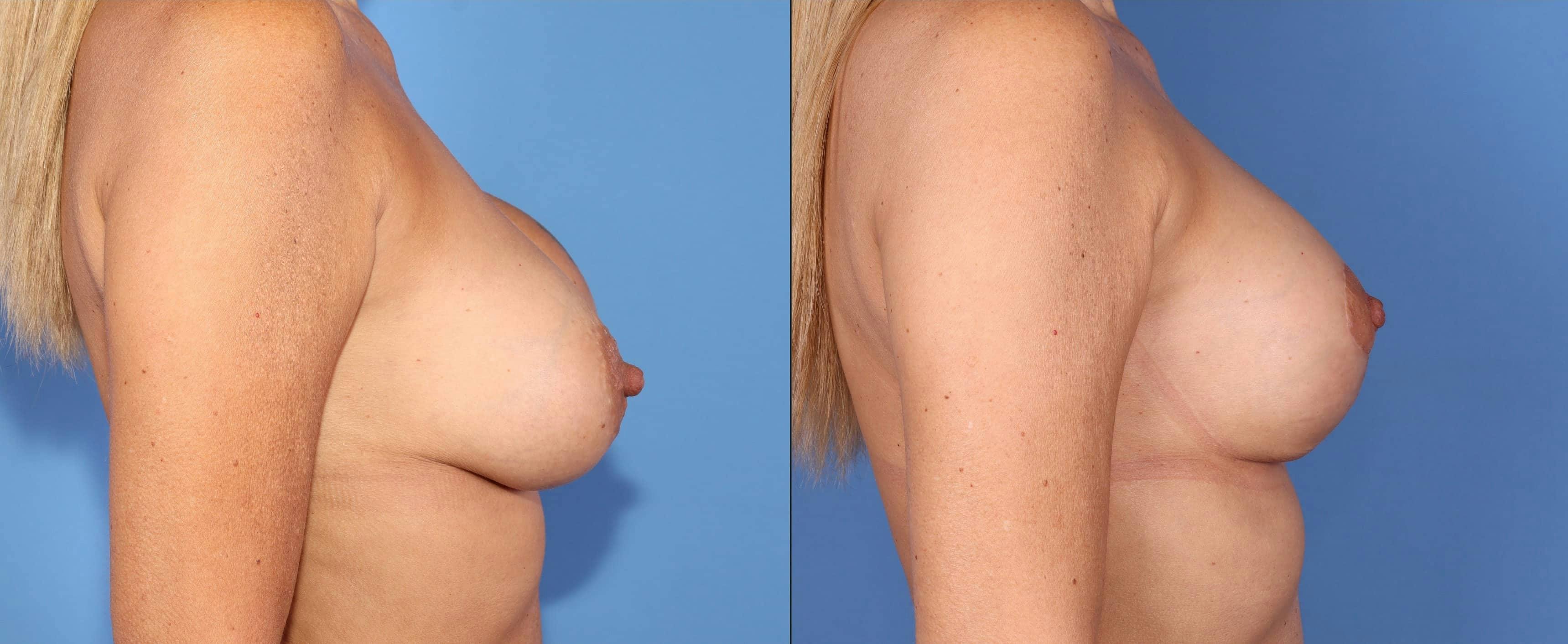 Breast Implant Revision Before & After Gallery - Patient 102927414 - Image 3