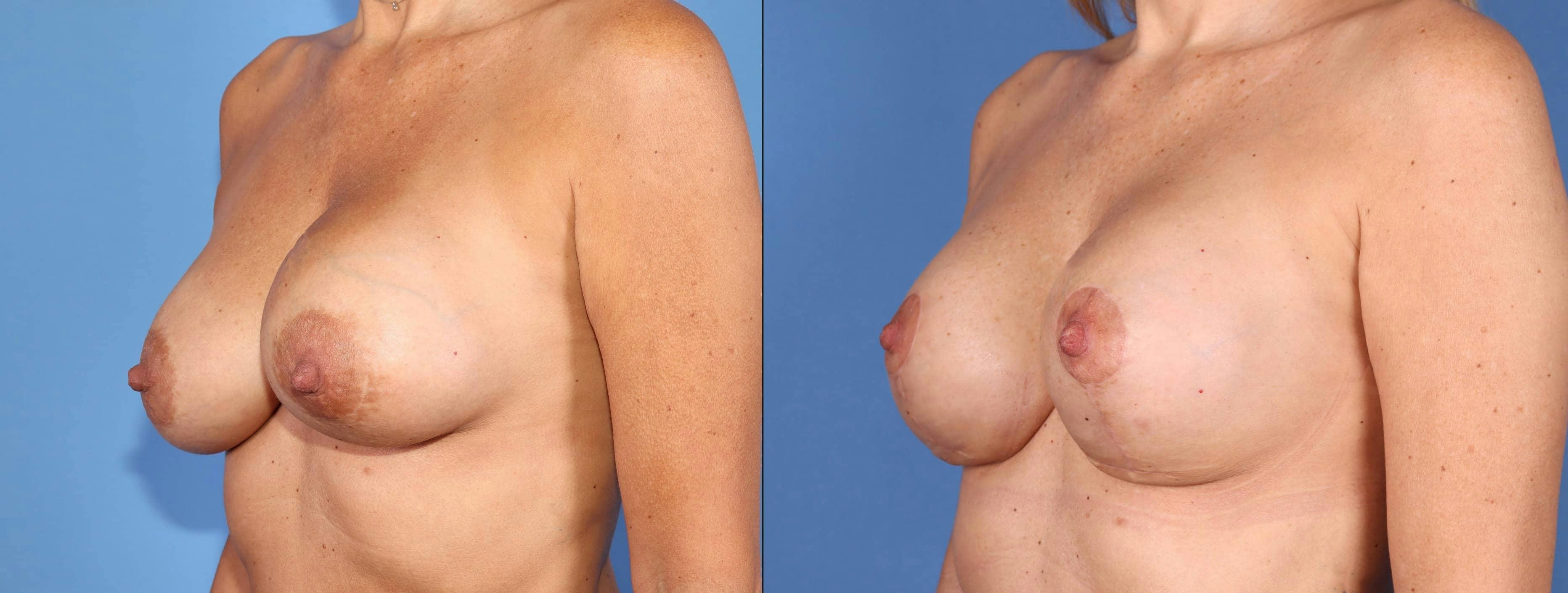 Breast Implant Revision Before & After Gallery - Patient 102927414 - Image 4