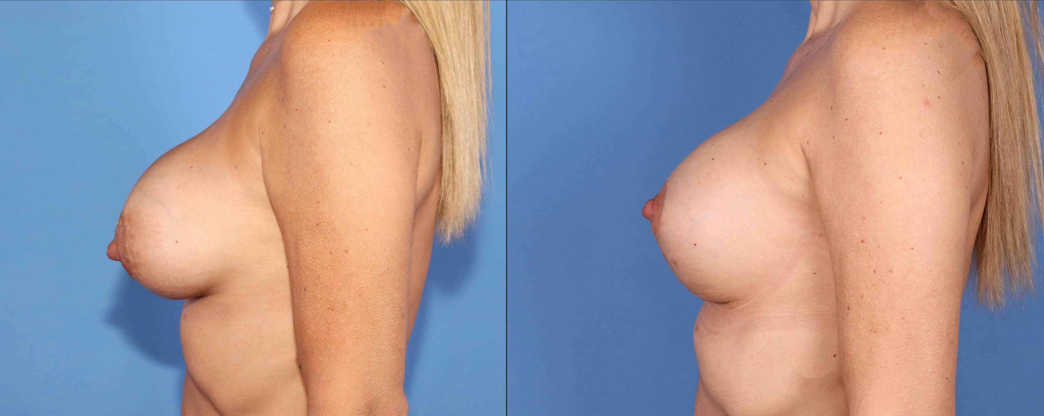 Breast Implant Revision Before & After Gallery - Patient 102927414 - Image 5