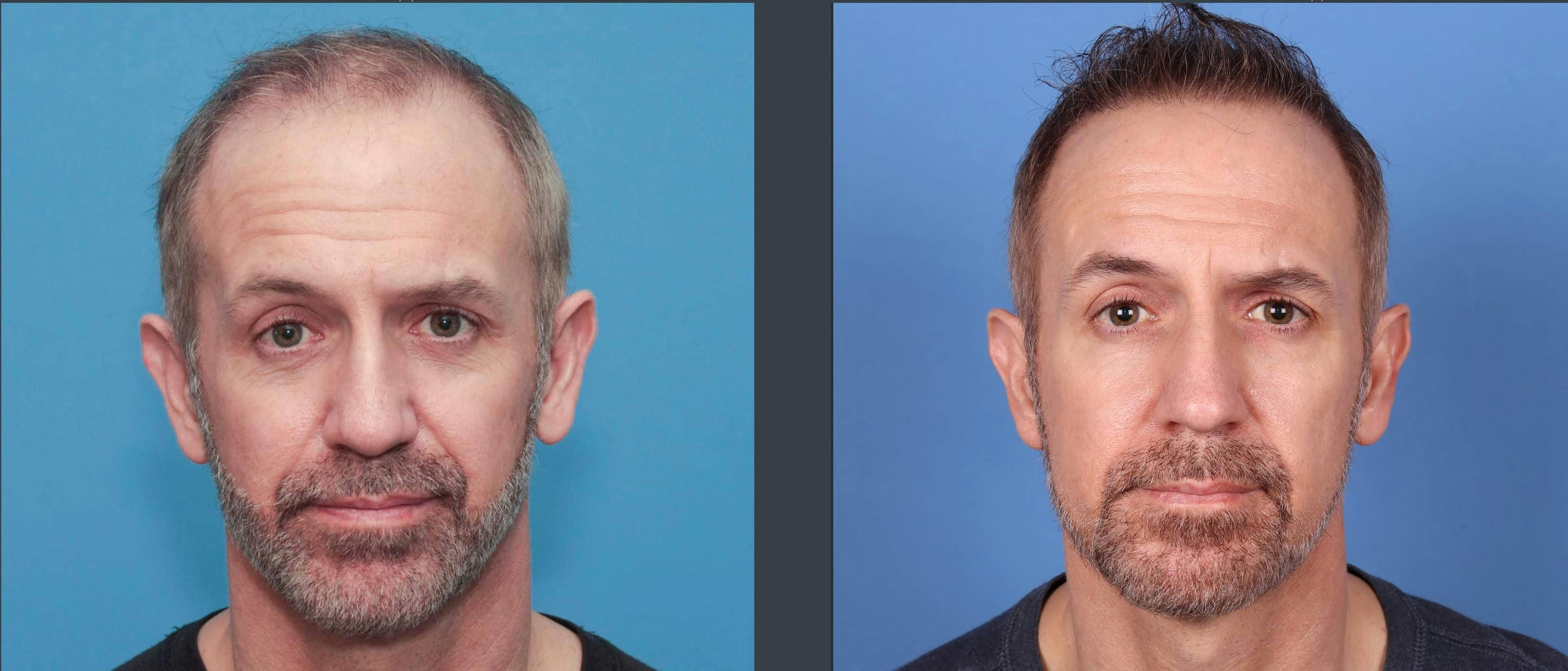 NeoGraft Hair Restoration Before & After Gallery - Patient 103407567 - Image 1