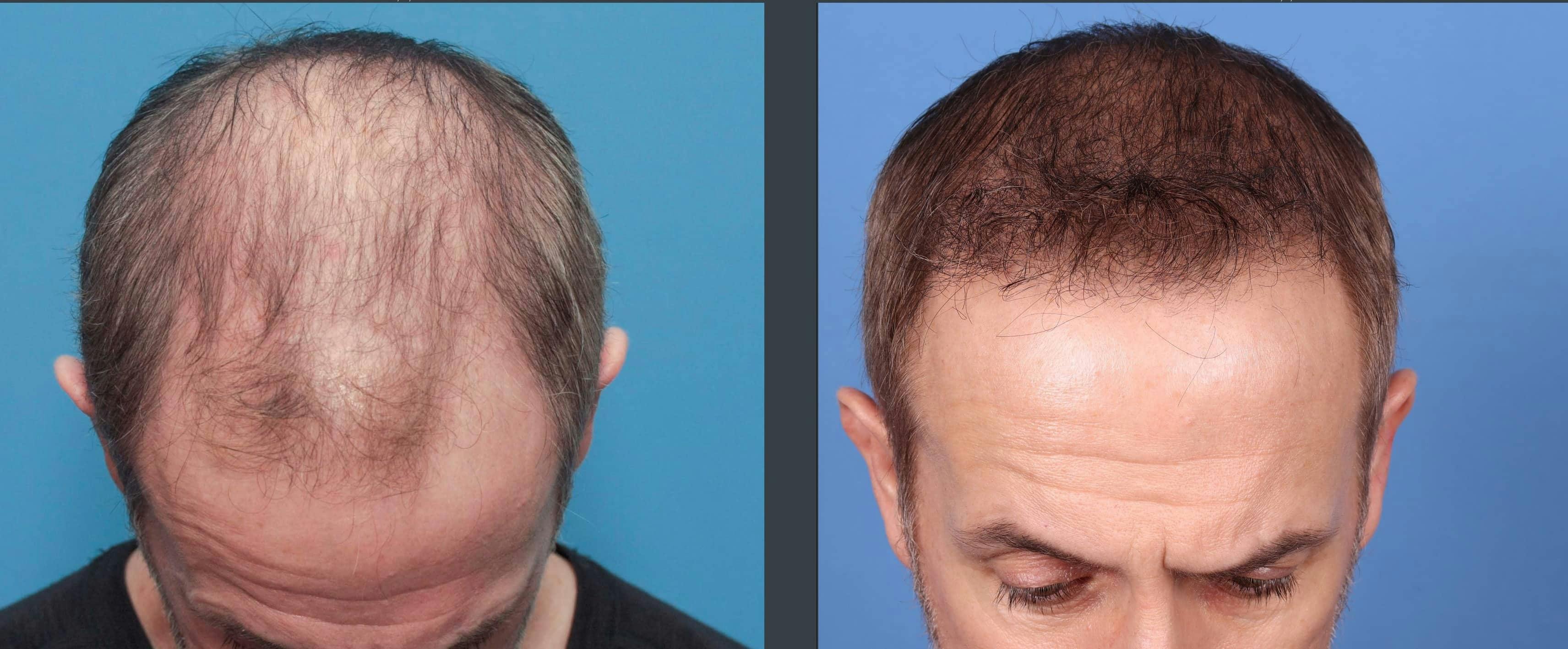 NeoGraft Hair Restoration Before & After Gallery - Patient 103407567 - Image 2