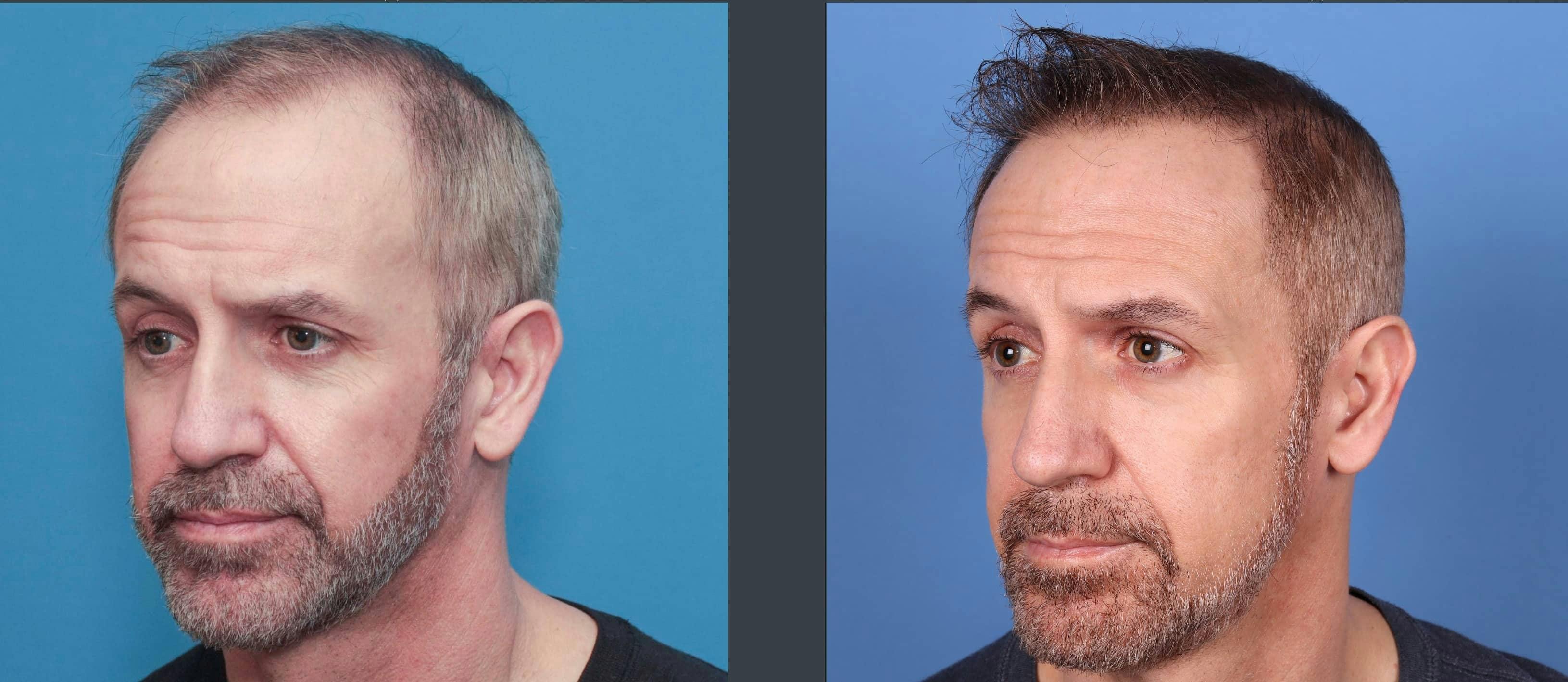 NeoGraft Hair Restoration Before & After Gallery - Patient 103407567 - Image 3