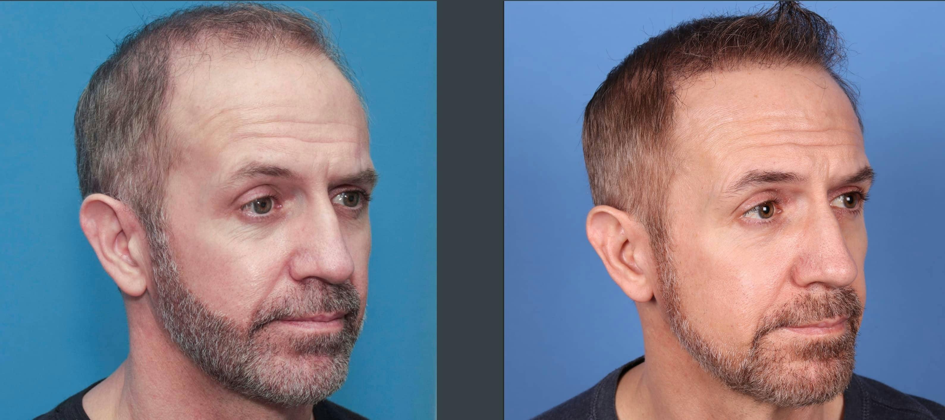 NeoGraft Hair Restoration Before & After Gallery - Patient 103407567 - Image 7