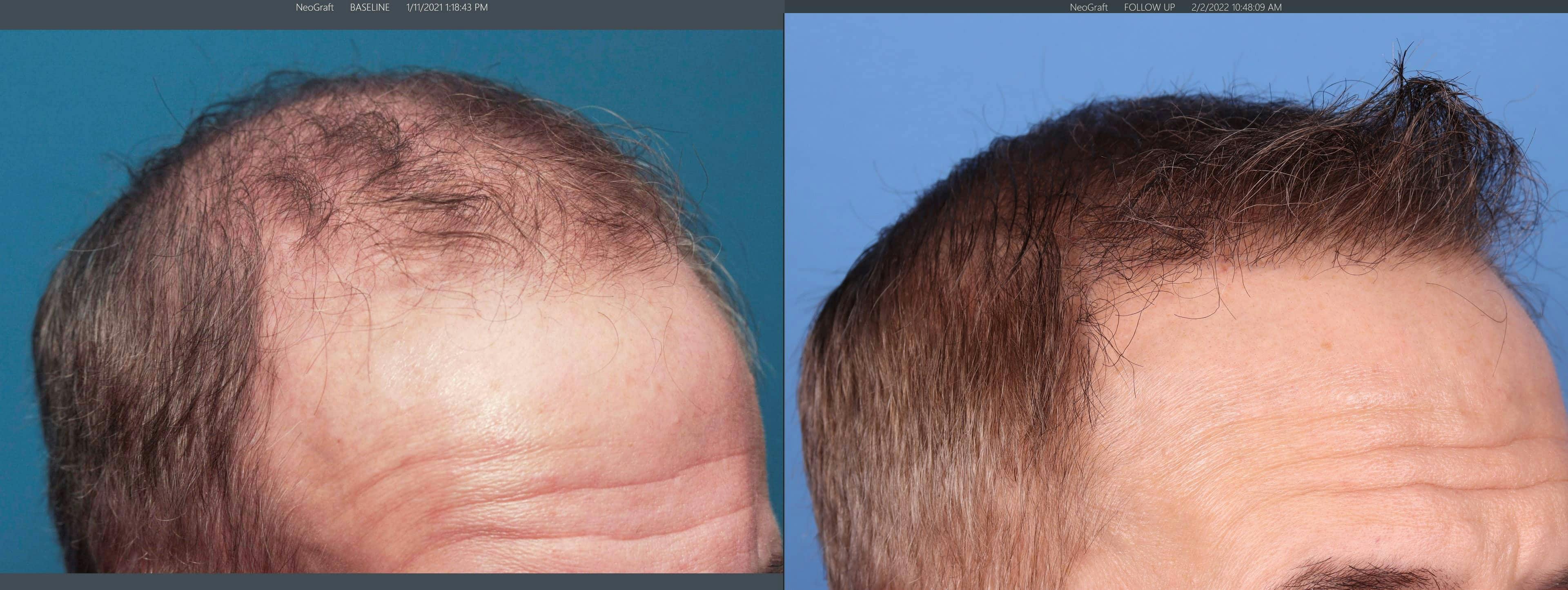 NeoGraft Hair Restoration Before & After Gallery - Patient 103407567 - Image 5