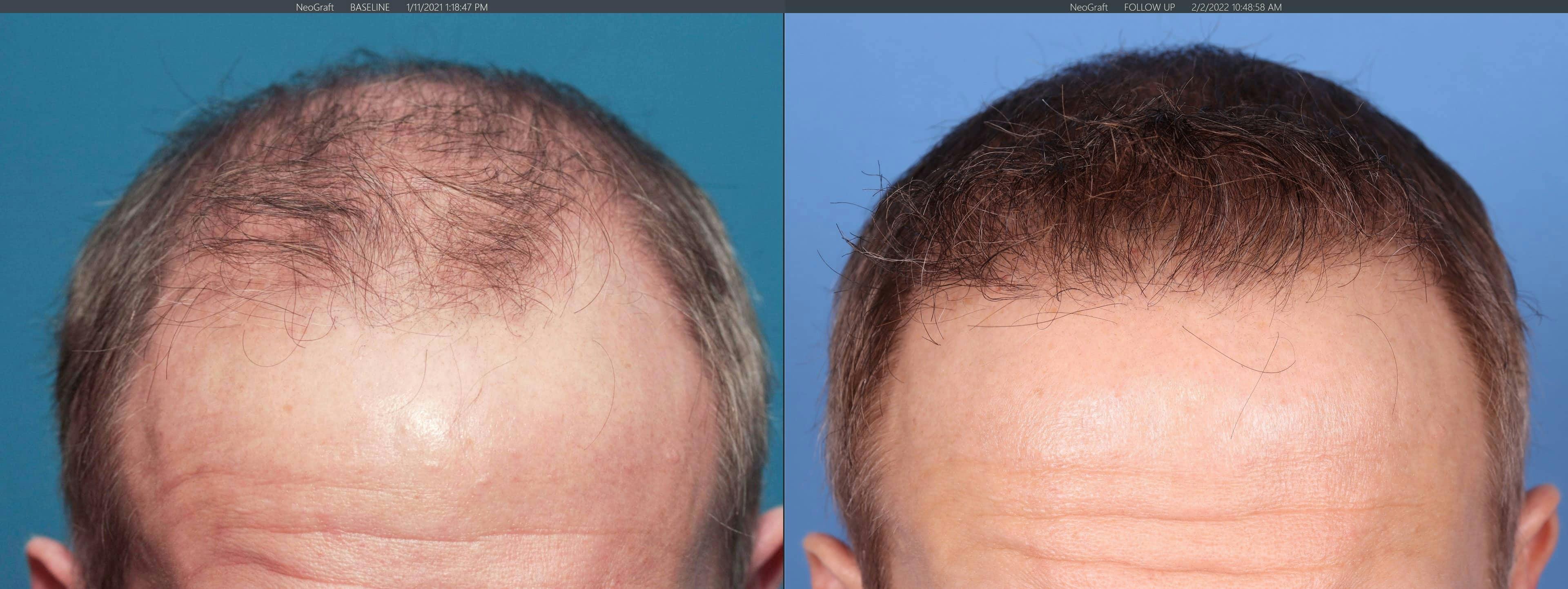 NeoGraft Hair Restoration Before & After Gallery - Patient 103407567 - Image 1