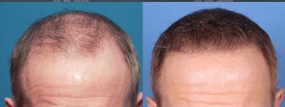 NeoGraft Hair Restoration Before & After Gallery - Patient 103407567 - Image 1