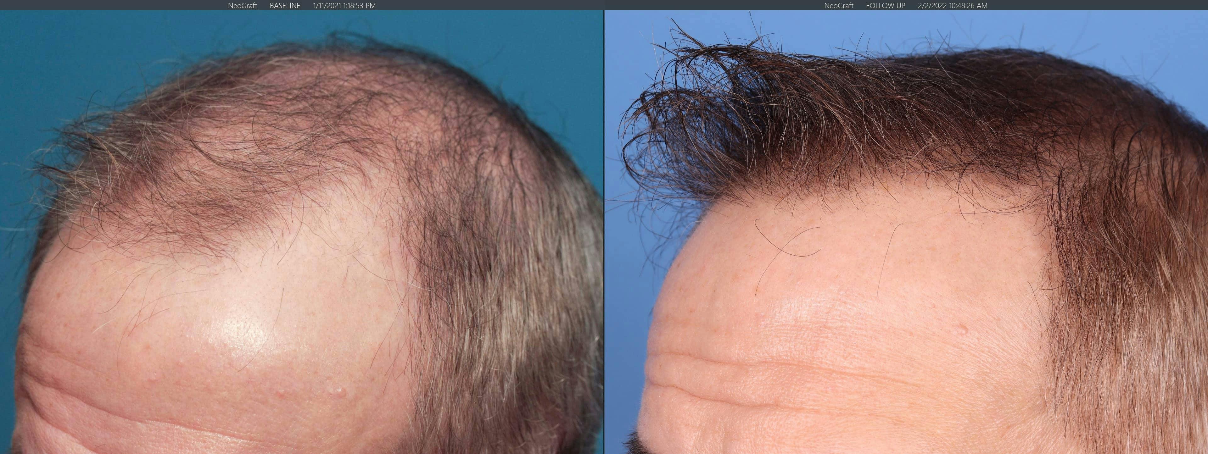 NeoGraft Hair Restoration Before & After Gallery - Patient 103407567 - Image 7