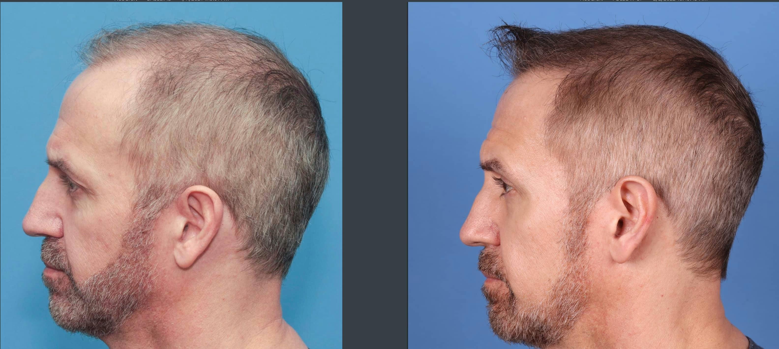 NeoGraft Hair Restoration Before & After Gallery - Patient 103407567 - Image 8