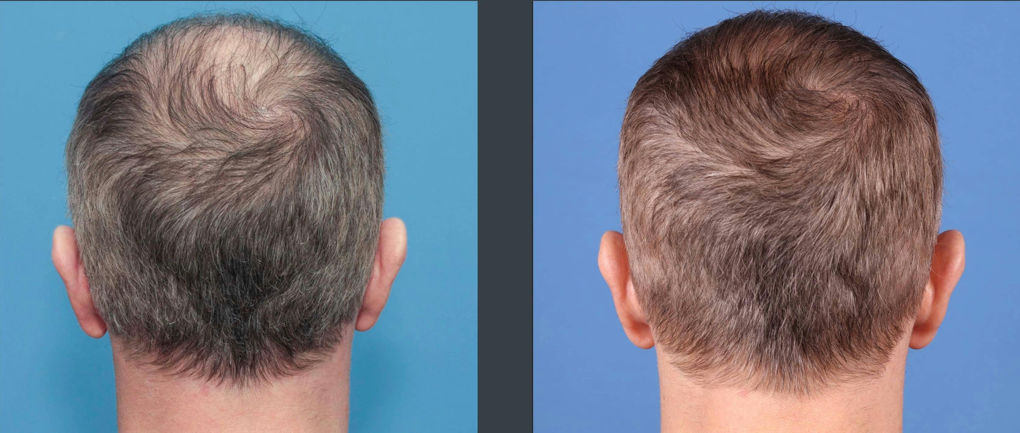 NeoGraft Hair Restoration Before & After Gallery - Patient 103407567 - Image 9