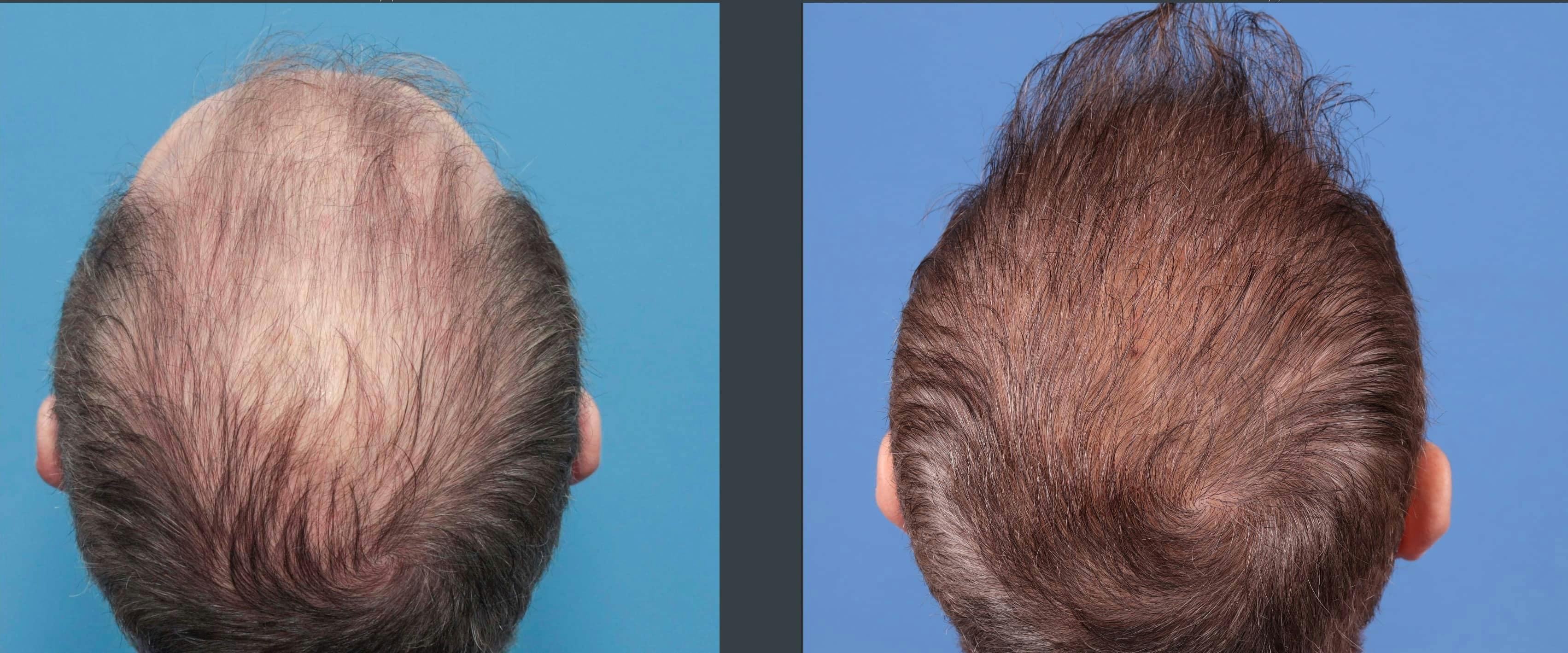 NeoGraft Hair Restoration Before & After Gallery - Patient 103407567 - Image 10
