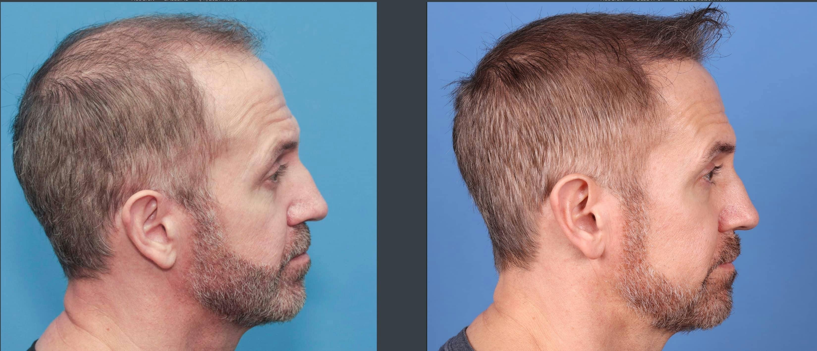 NeoGraft Hair Restoration Before & After Gallery - Patient 103407567 - Image 11