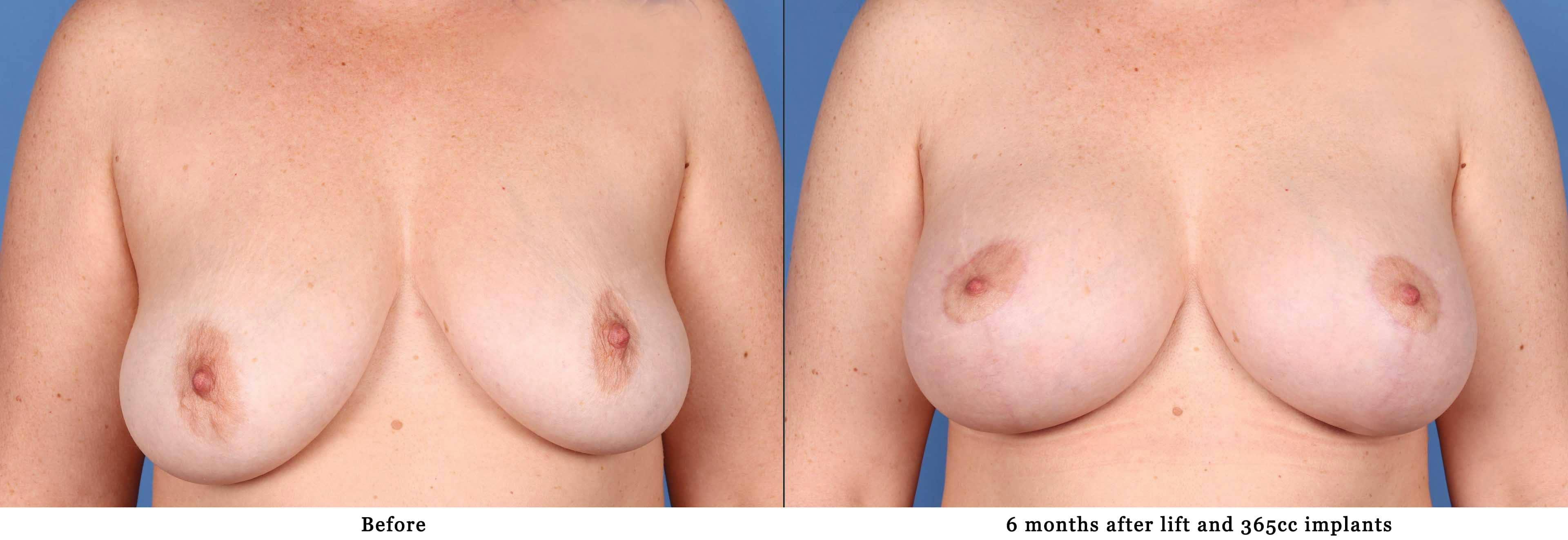 Breast Lift with Augmentation Before & After Gallery - Patient 108420926 - Image 1