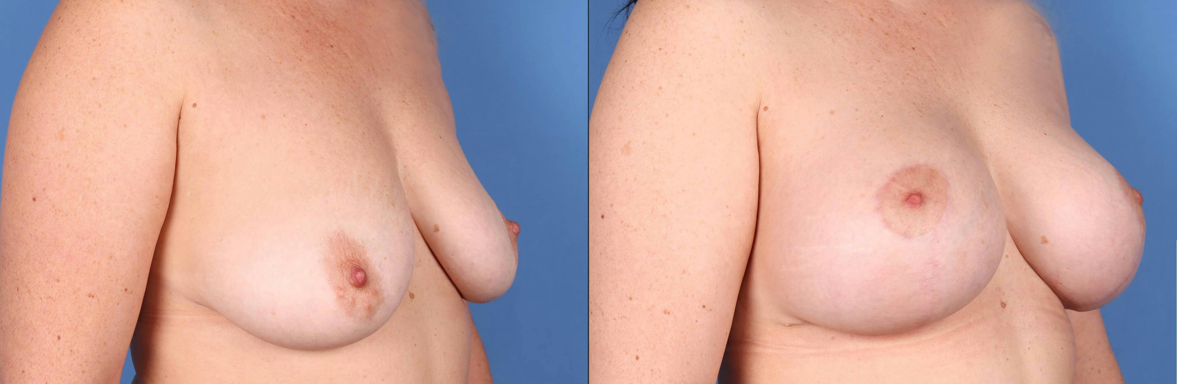Breast Lift with Augmentation Before & After Gallery - Patient 108420926 - Image 3