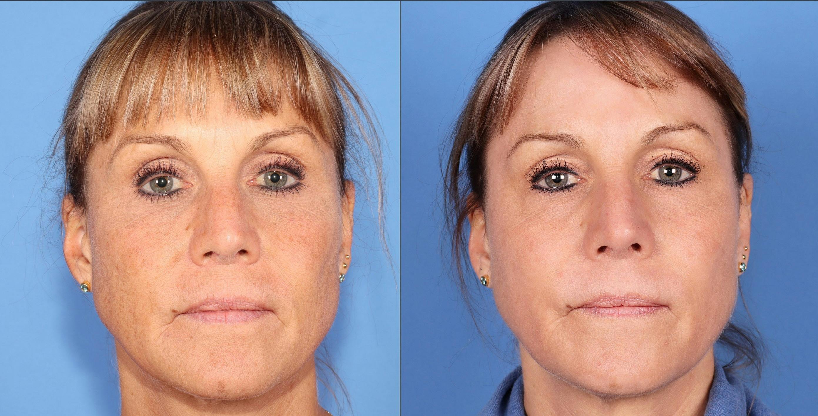 Contour TRL Laser Before & After Gallery - Patient 112545907 - Image 1