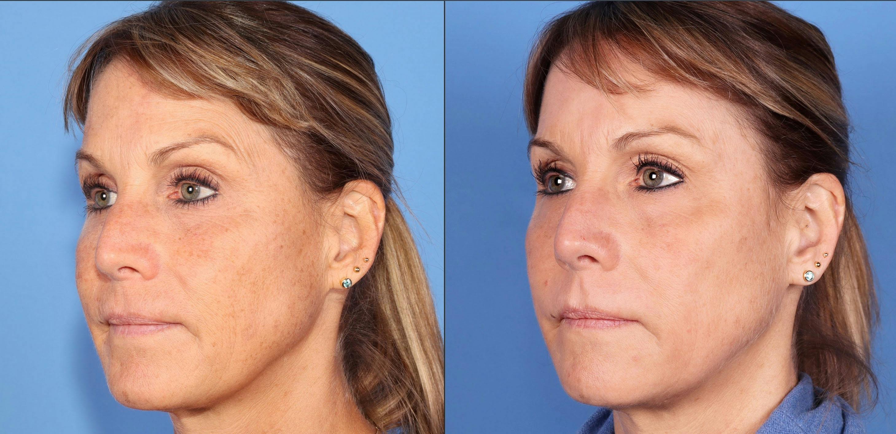 Contour TRL Laser Before & After Gallery - Patient 112545907 - Image 2