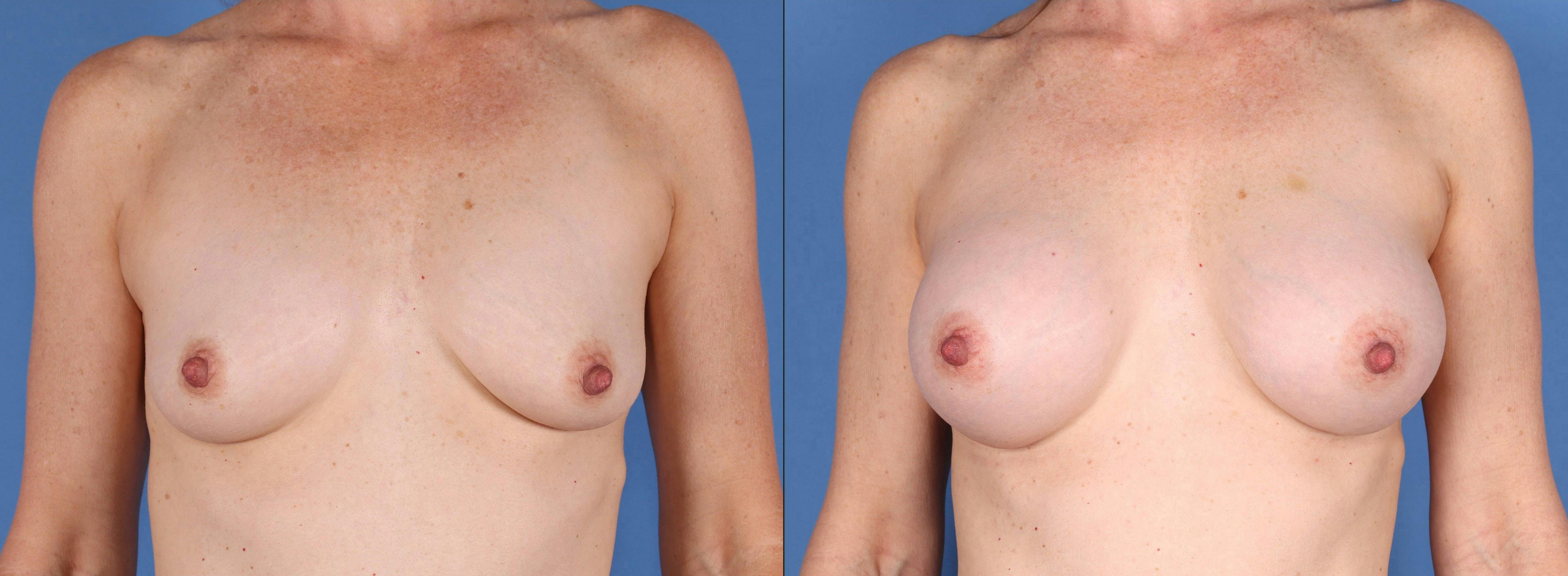 Breast Augmentation Before & After Gallery - Patient 112546978 - Image 1