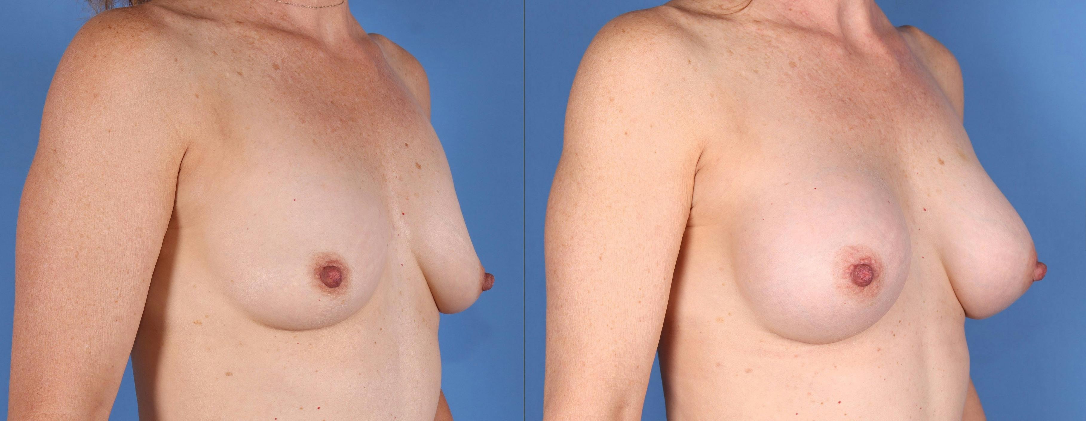Breast Augmentation Before & After Gallery - Patient 112546978 - Image 2