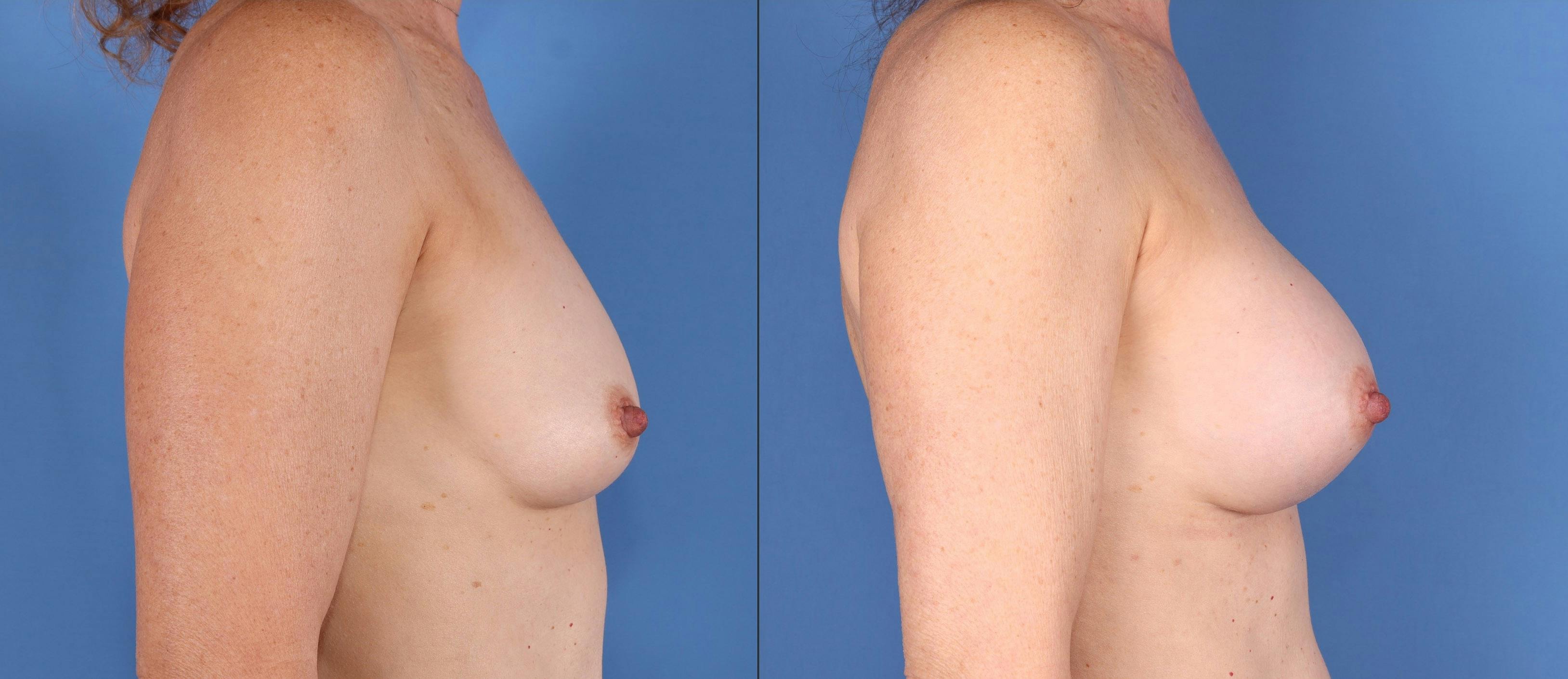 Breast Augmentation Before & After Gallery - Patient 112546978 - Image 3