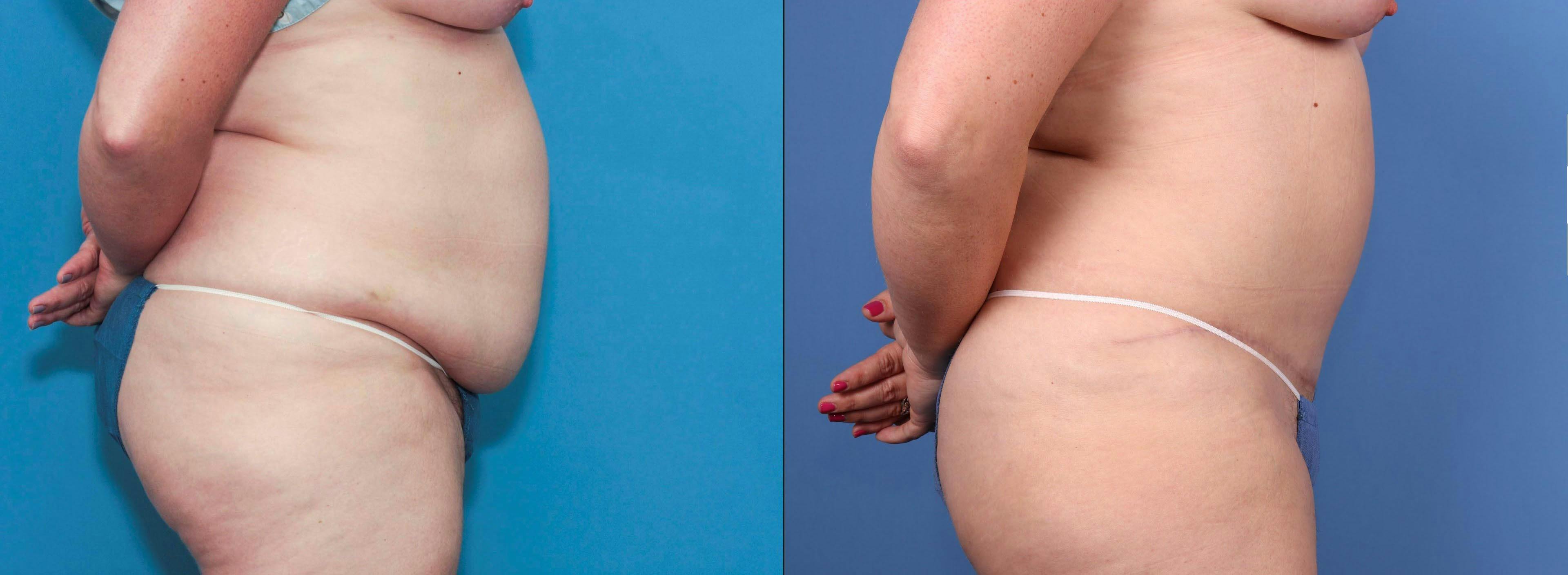 Liposuction Before & After Gallery - Patient 112550843 - Image 3