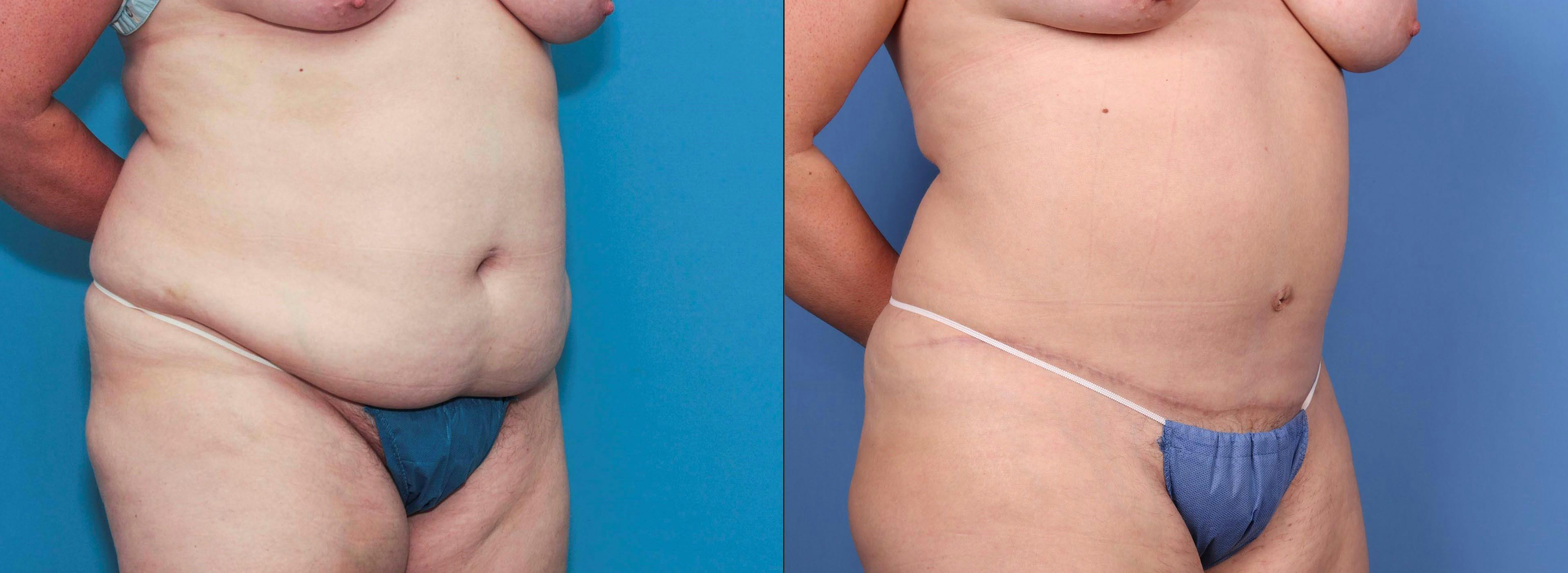 Abdomen Before & After Gallery - Patient 149385227 - Image 2