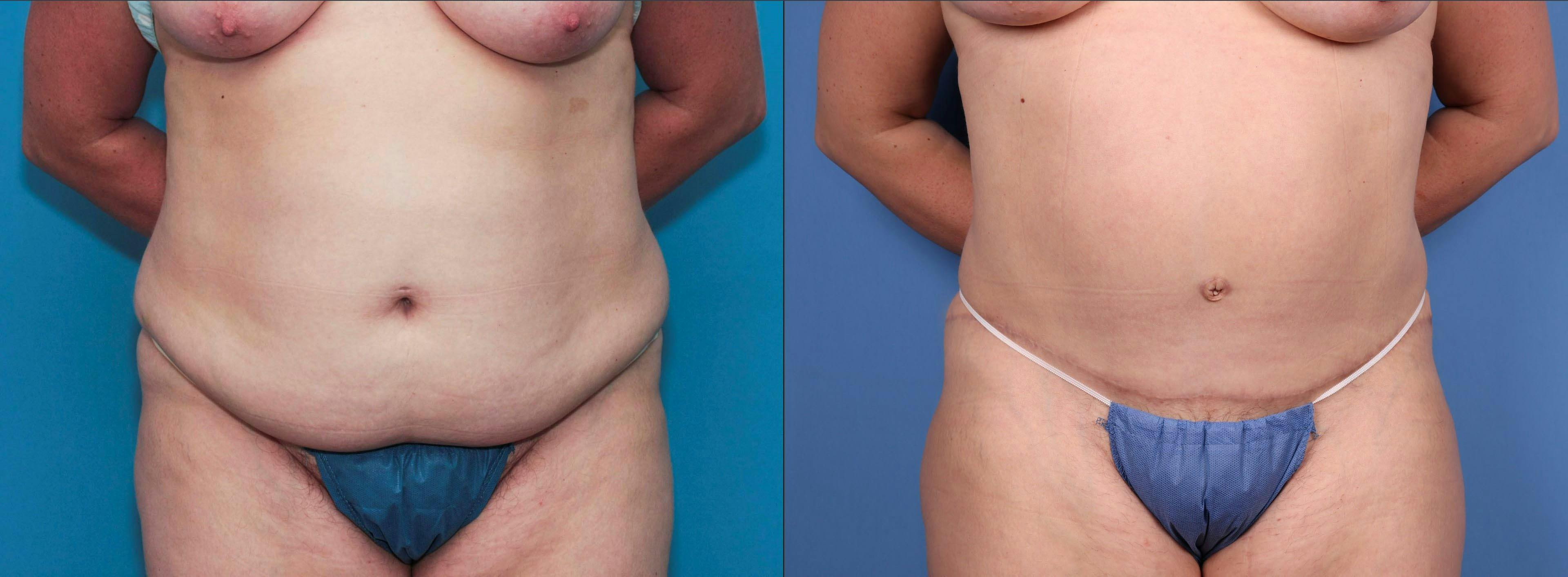 Tummy Tuck Before & After Gallery - Patient 112550789 - Image 1