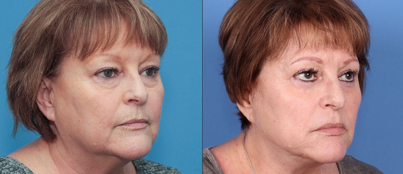 Eyelid Surgery (Blepharoplasty) Before & After Gallery - Patient 114615382 - Image 2