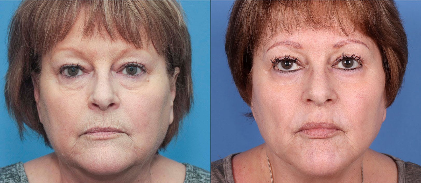 Face Lift Before & After Gallery - Patient 114615323 - Image 1