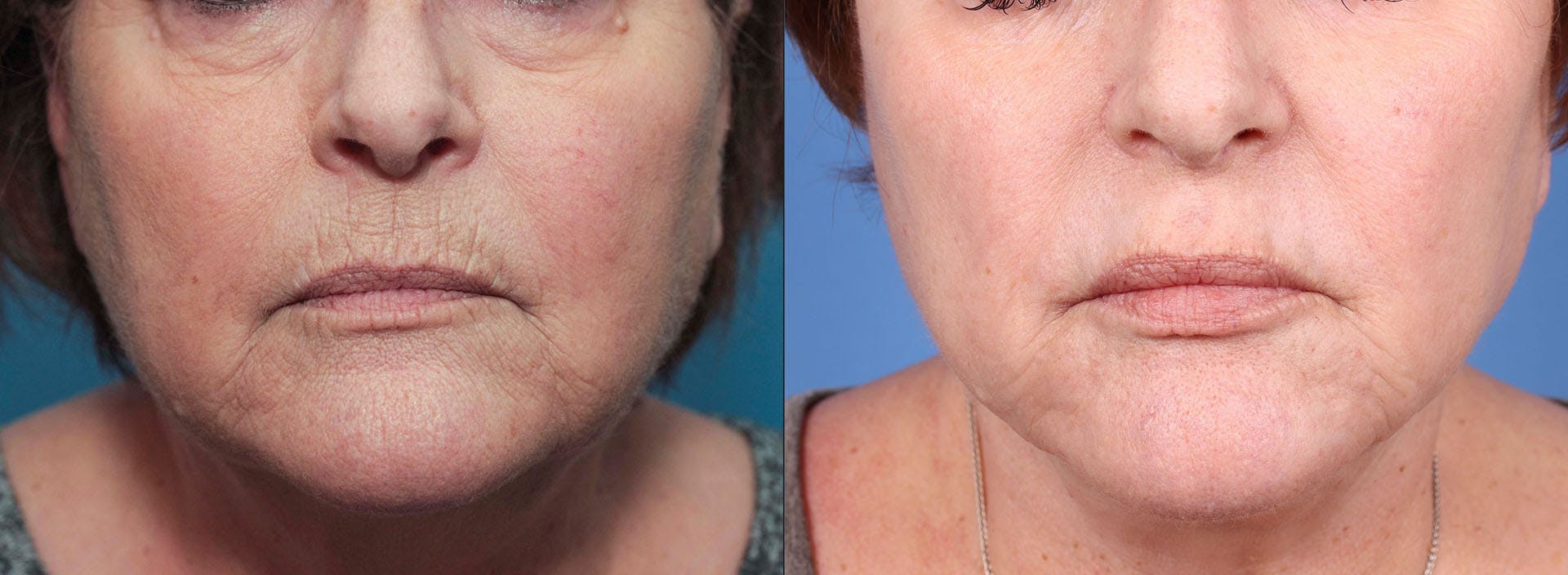 Face Lift Before & After Gallery - Patient 114615323 - Image 3