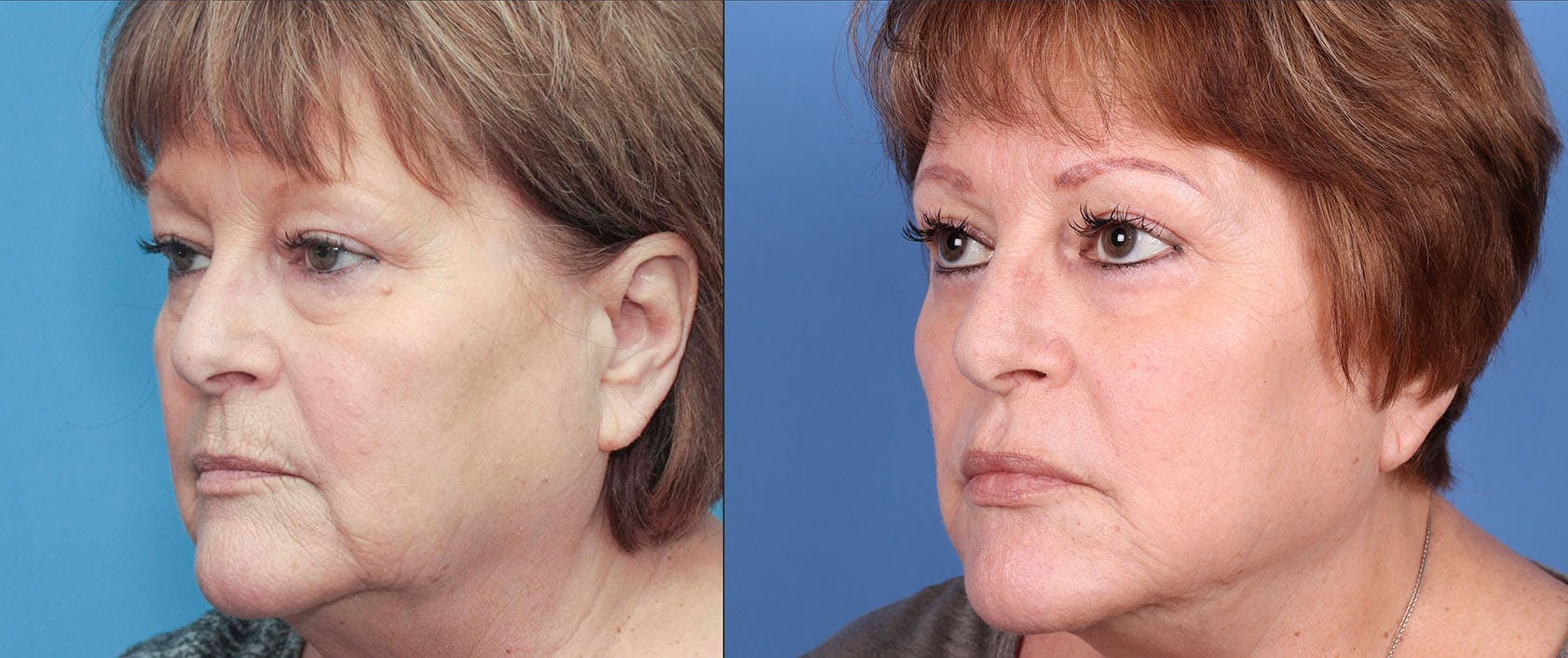 Neck Lift Before & After Gallery - Patient 114615364 - Image 1