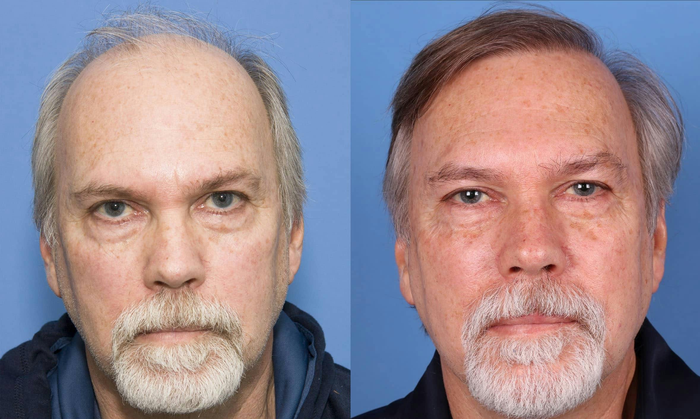 NeoGraft Hair Restoration Before & After Gallery - Patient 114700722 - Image 1