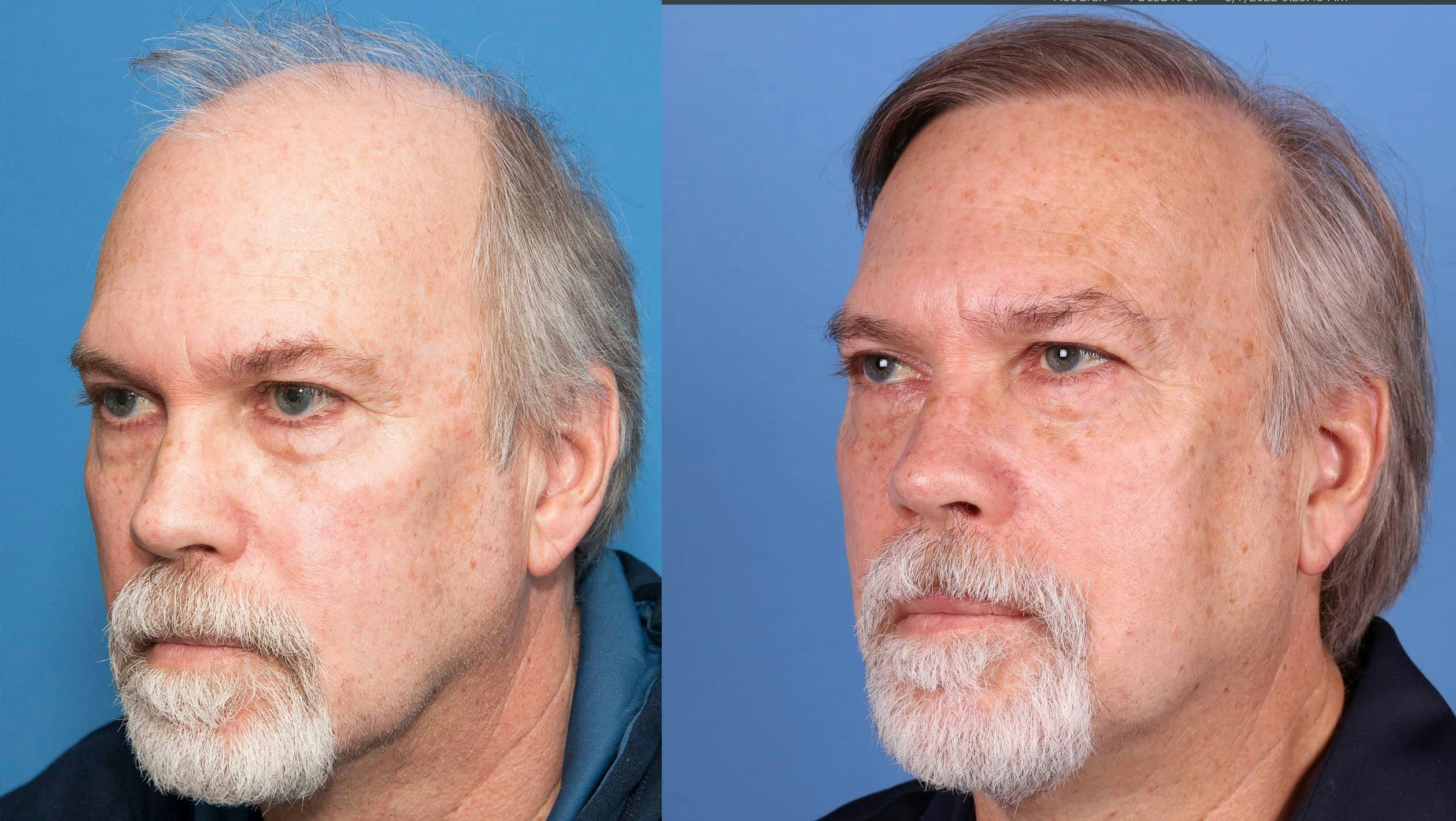 NeoGraft Hair Restoration Before & After Gallery - Patient 114700722 - Image 2