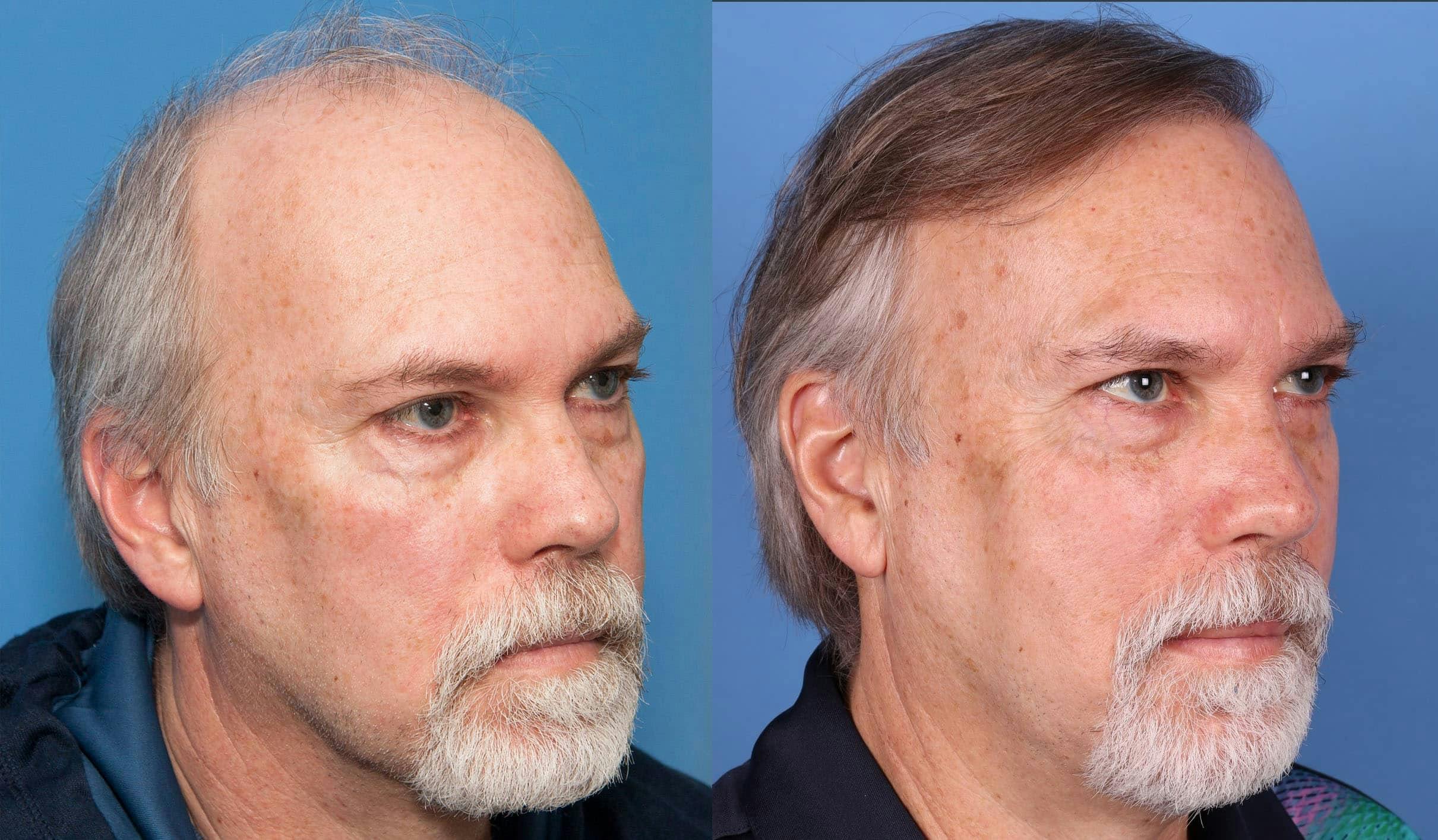NeoGraft Hair Restoration Before & After Gallery - Patient 114700722 - Image 3