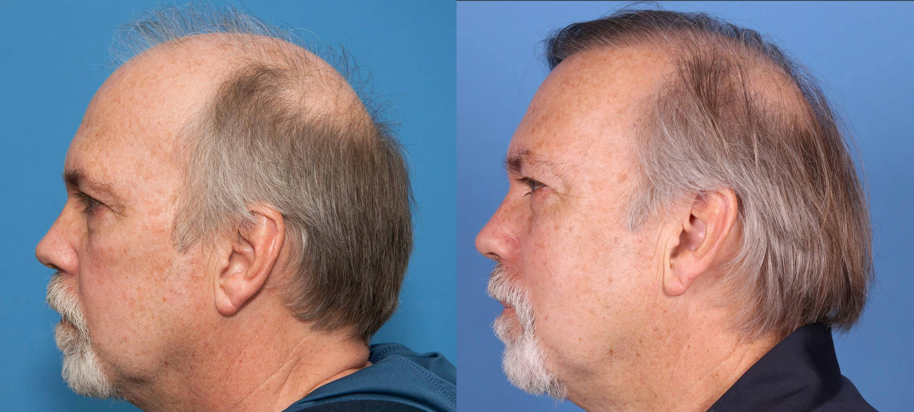 NeoGraft Hair Restoration Before & After Gallery - Patient 114700722 - Image 4