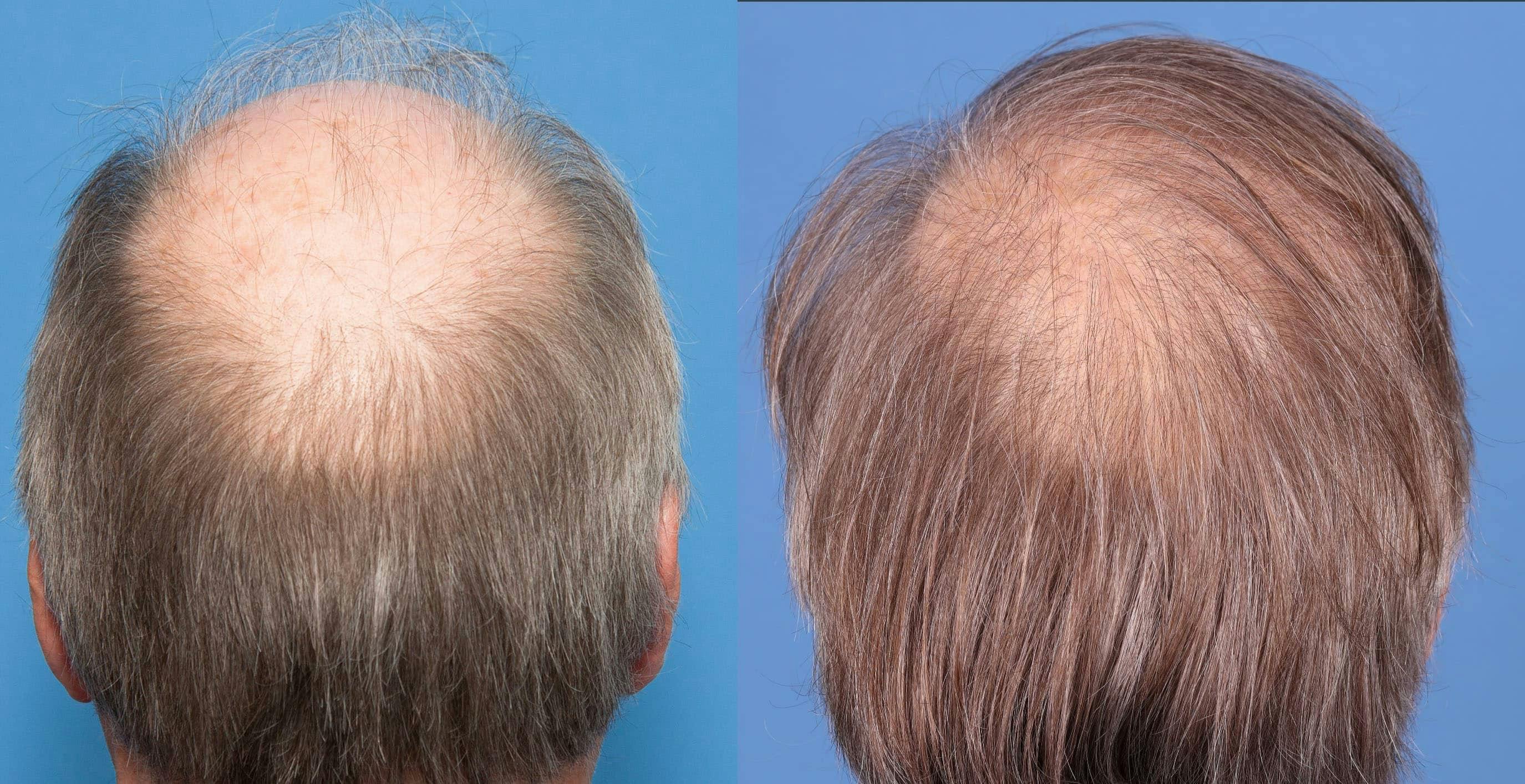 NeoGraft Hair Restoration Before & After Gallery - Patient 114700722 - Image 5