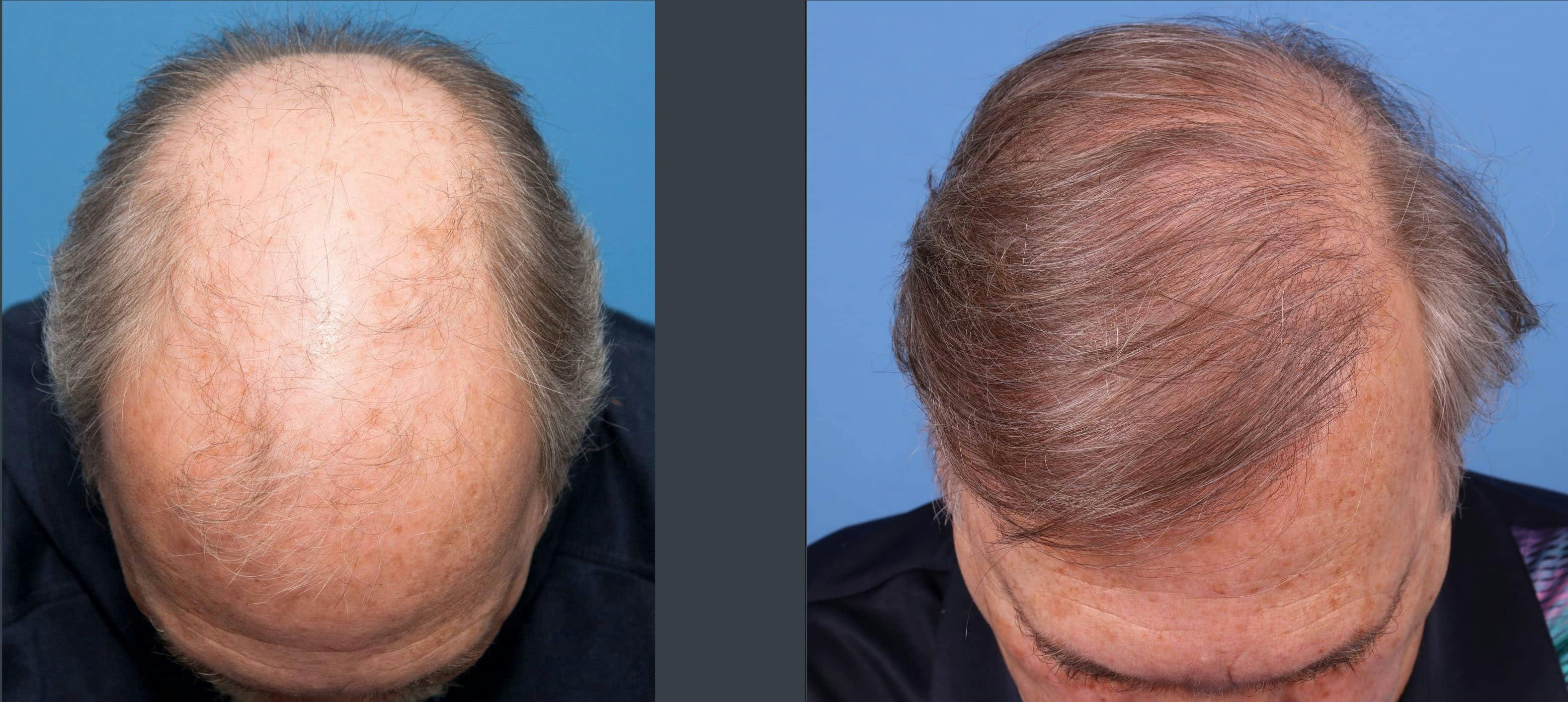 NeoGraft Hair Restoration Before & After Gallery - Patient 114700722 - Image 6
