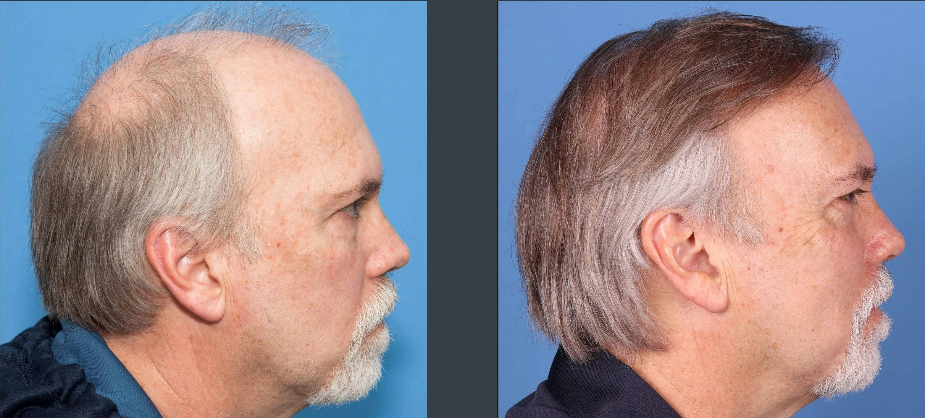 NeoGraft Hair Restoration Before & After Gallery - Patient 114700722 - Image 7