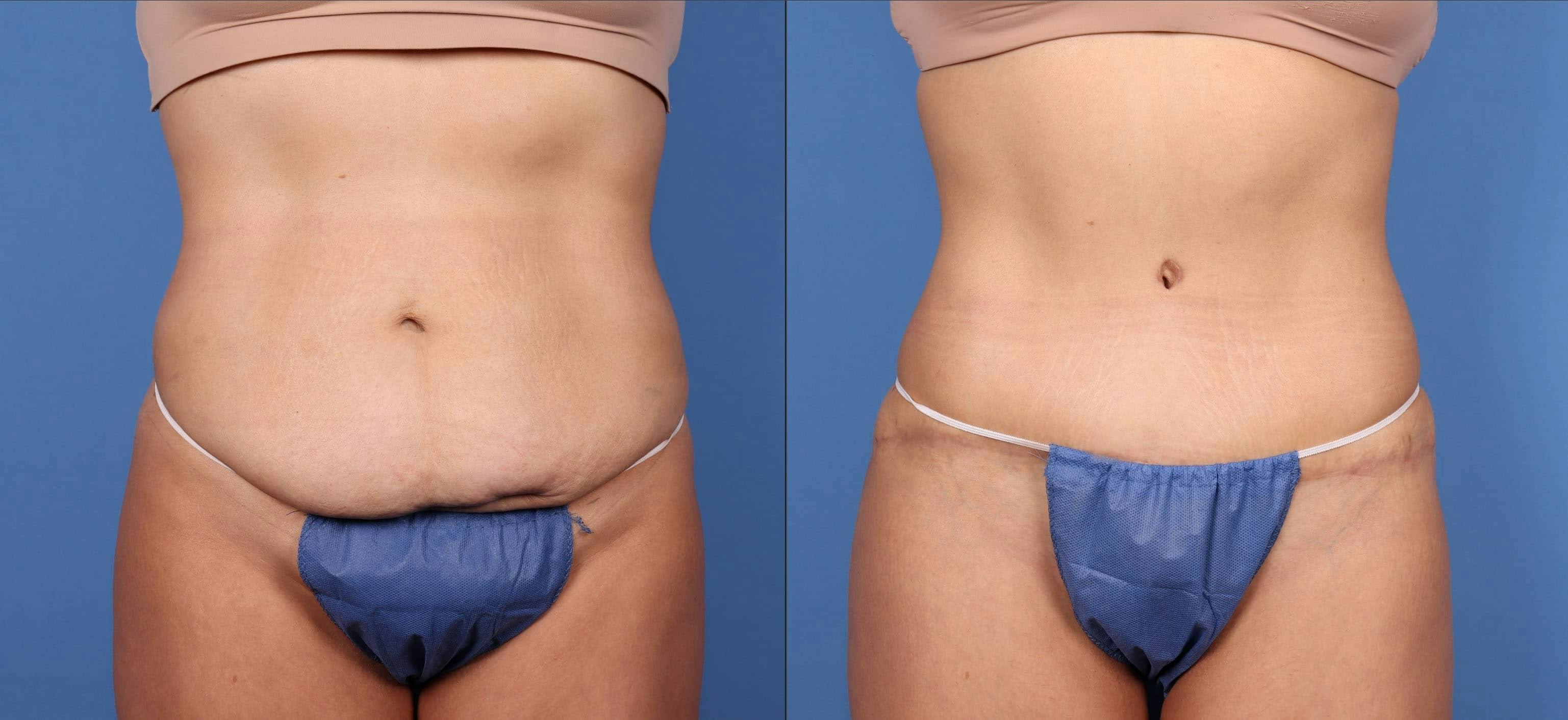 Tummy Tuck Before & After Gallery - Patient 114701284 - Image 1