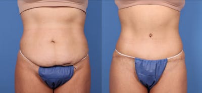 Tummy Tuck Before & After Gallery - Patient 114701284 - Image 1