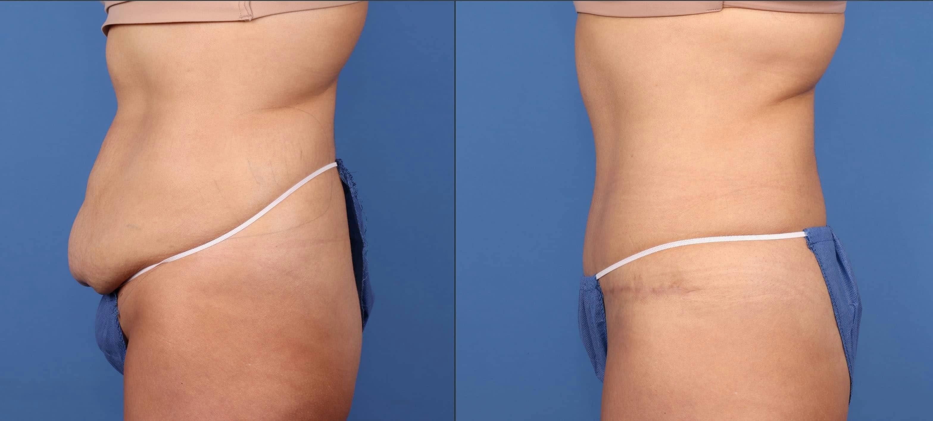Tummy Tuck Before & After Gallery - Patient 114701284 - Image 2
