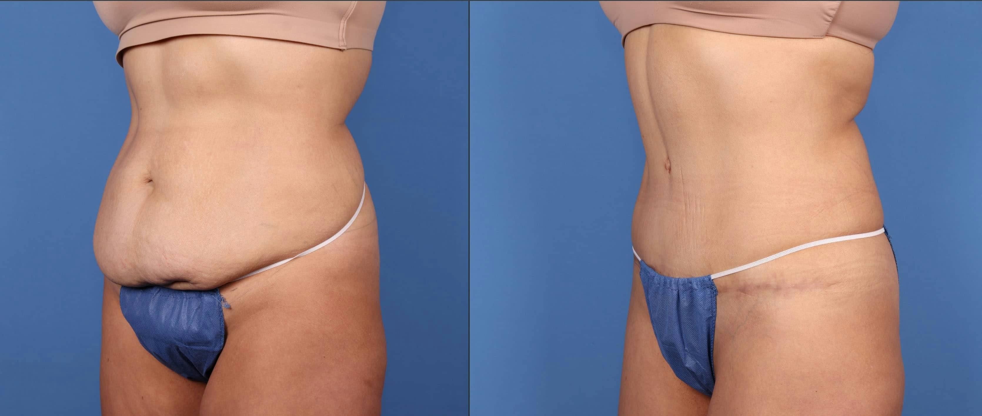 Abdomen Before & After Gallery - Patient 149385225 - Image 3