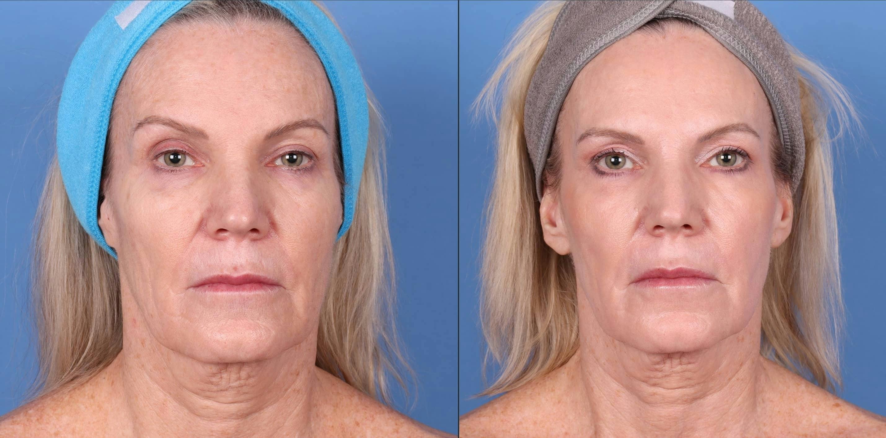Contour TRL Laser Before & After Gallery - Patient 114701450 - Image 1