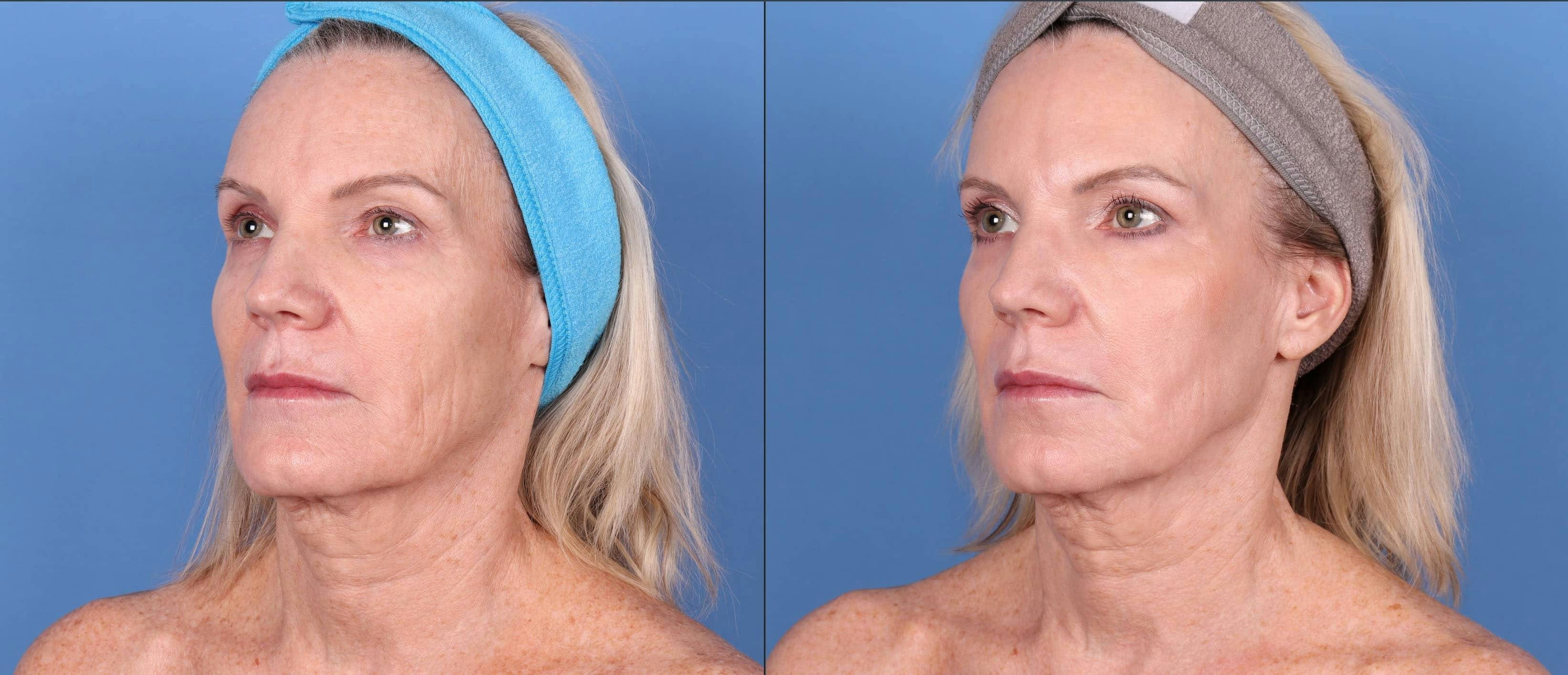 Contour TRL Laser Before & After Gallery - Patient 114701450 - Image 2